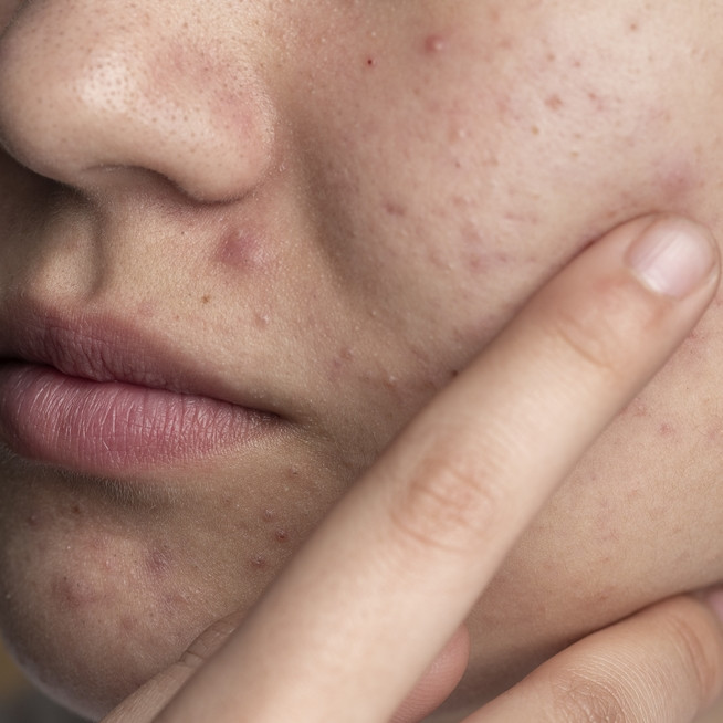 10 Krim pagi menghilangkan bruntusan di pipi harga di bawah Rp 100 ribu