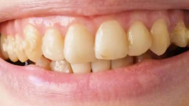 Dua minyak ajaib ini bisa hapus plak dan bau mulut tanpa garam atau lemon, hasilnya bikin puas