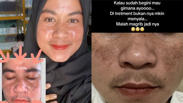 Merkuri bikin flek hitam, kisah perjuangan emak-emak cerahkan wajah saat hamil ini jadi sorotan