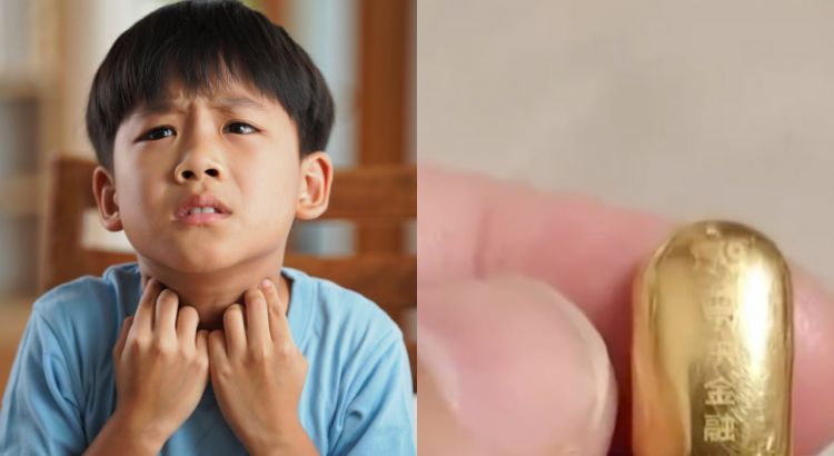 Gara-gara tak sengaja telan emas seharga Rp23 juta, bocah ini dilarang BAB sembarangan