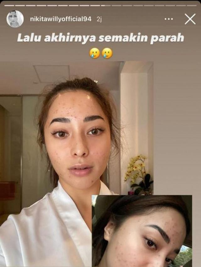Bukti cantik nggak harus mulus, 11 potret seleb ini tampil percaya diri dengan wajah berjerawat
