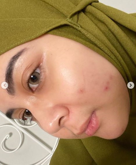 Bukti cantik nggak harus mulus, 11 potret seleb ini tampil percaya diri dengan wajah berjerawat