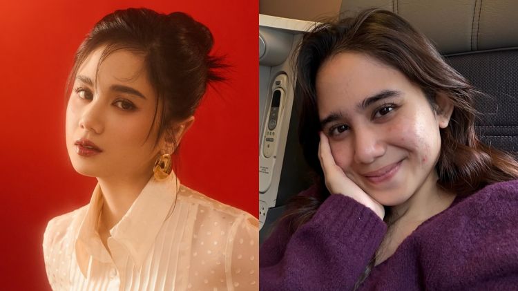 Bukti cantik nggak harus mulus, 11 potret seleb ini tampil percaya diri dengan wajah berjerawat