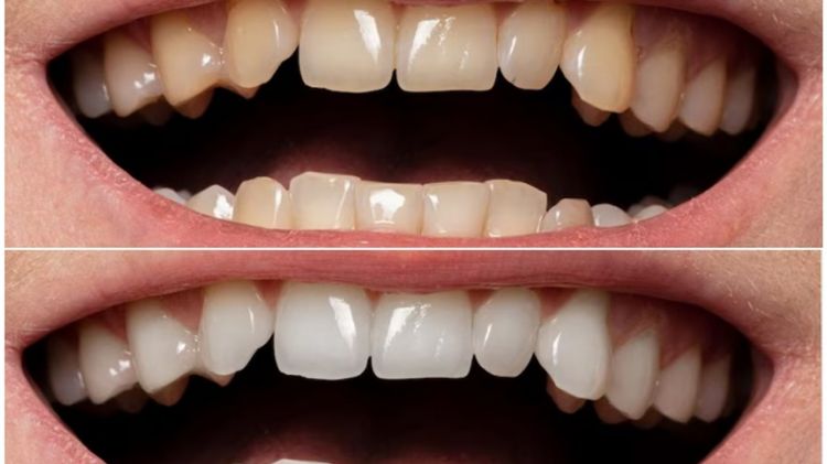 Trik memutihkan gigi kuning membandel cuma pakai 3 jenis buah, tanpa pakai garam