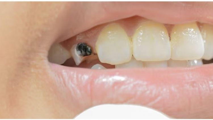 Gigi hitam kembali putih menggunakan 1 jenis biji-bijian, triknya tak perlu pakai baking soda