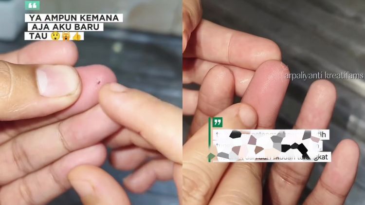 Tanpa rasa sakit, ini trik keluarkan duri di jari tangan pakai 1 bahan dapur, mudah tak perlu dipijat 