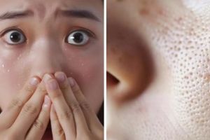 7 Kandungan skincare ampuh untuk komedo putih, bikin kulit makin bersih dan bebas minyak