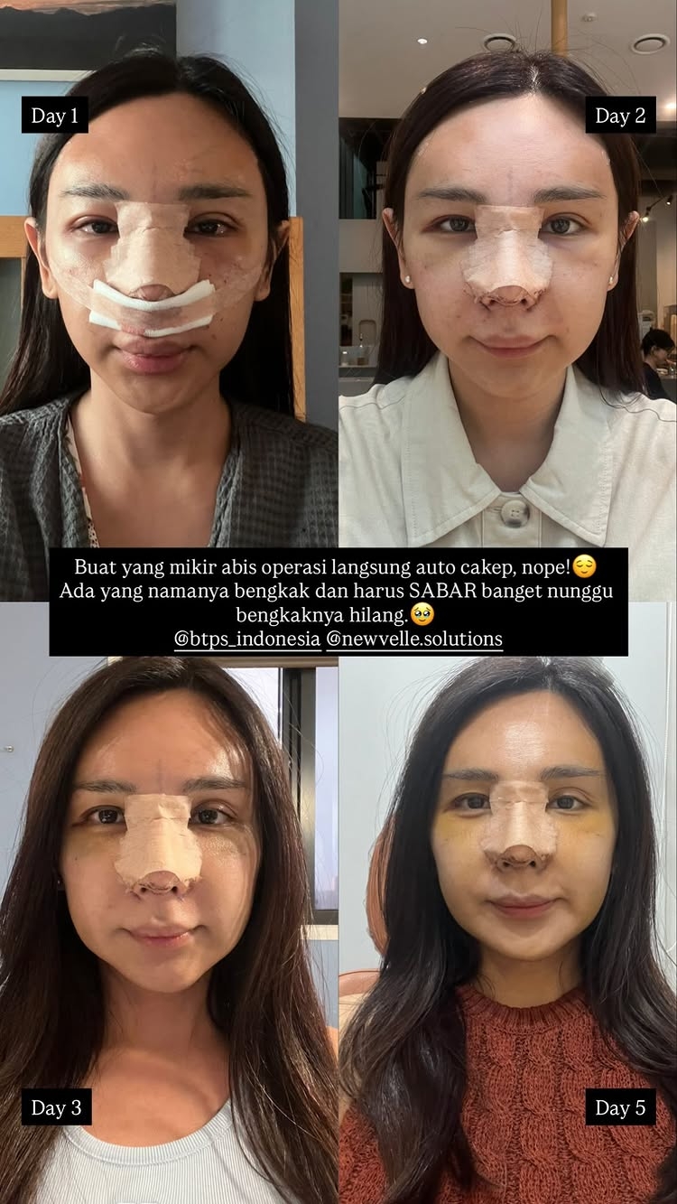Ingin perbaiki hidung bengkok, ini 7 potret Dena Rachman jalani rhinoplasty dan fat graft