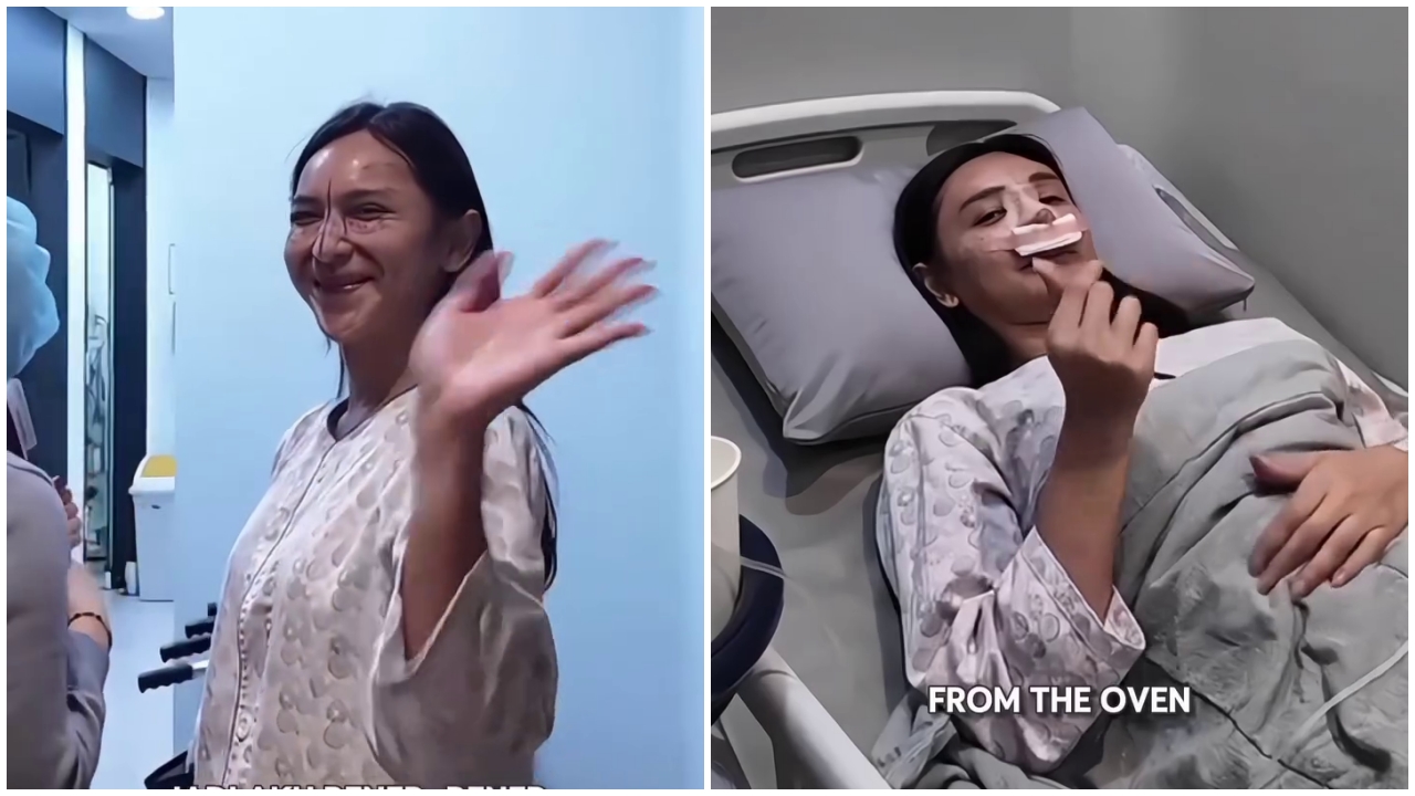 Ingin perbaiki hidung bengkok, ini 7 potret Dena Rachman jalani rhinoplasty dan fat graft
