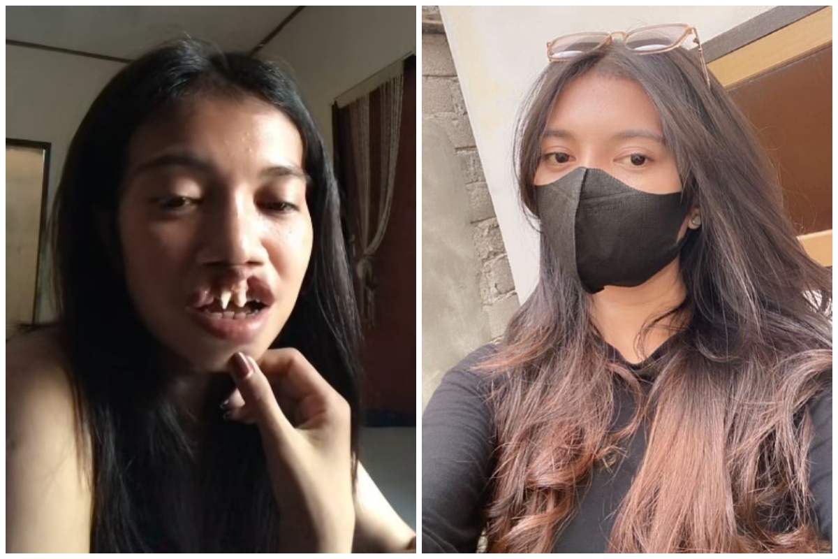 Ingat gadis bibir sumbing yang dioperasi gratis oleh Dokter Tompi? 9 potret terbarunya manglingi abis