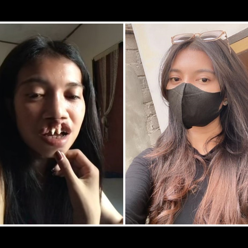 Ingat gadis bibir sumbing yang dioperasi gratis oleh Dokter Tompi? 9 potret terbarunya manglingi abis