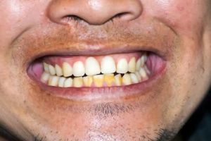 Plak kuning hilang gigi kembali putih cerah, coba trik pakai 1 bahan dapur