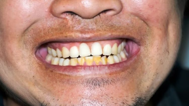 Plak kuning hilang gigi kembali putih cerah, coba trik pakai 1 bahan dapur