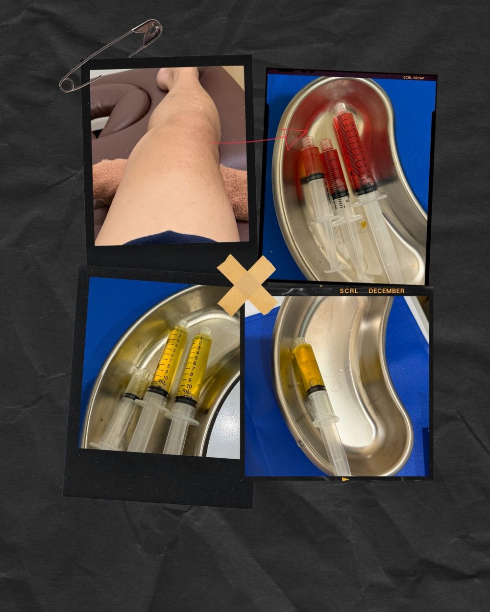 Alami cedera, Ariel Noah pakai penyangga di lutut saat main padel, beri penjelasan soal kondisinya