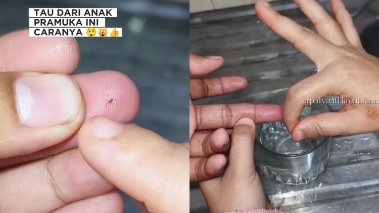 Trik keluarkan duri atau kayu kecil yang masuk ke kulit tanpa dicabut, cukup rendam 1 bahan dapur ini