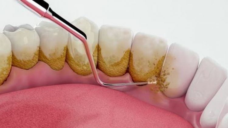 Luruhkan noda kuning dan plak gigi tanpa repot scaling, triknya pakai 2 bahan dapur