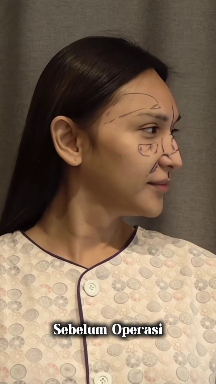 7 Potret Dena Rachman usai operasi plastik bagian hidung, dipuji makin cantik 