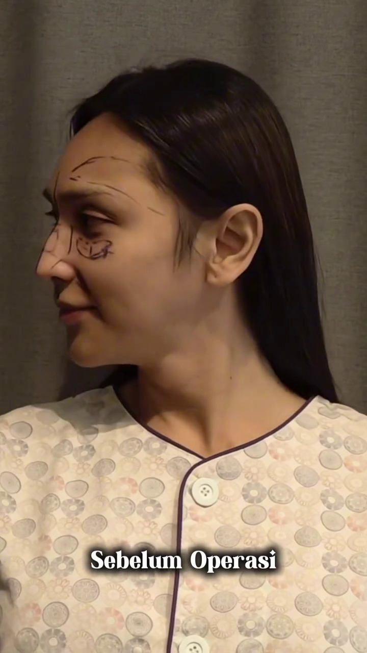 7 Potret Dena Rachman usai operasi plastik bagian hidung, dipuji makin cantik 