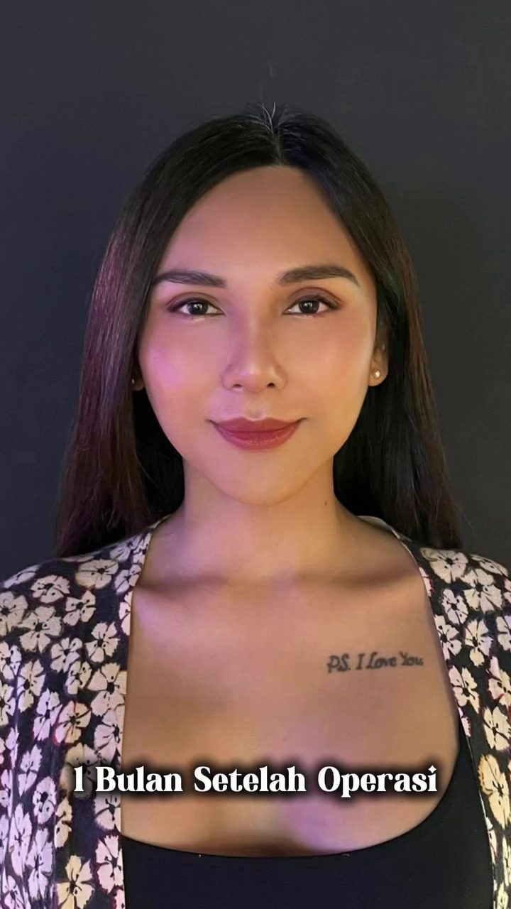 7 Potret Dena Rachman usai operasi plastik bagian hidung, dipuji makin cantik 