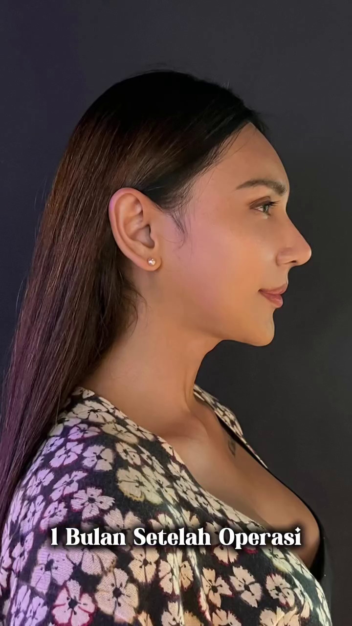 7 Potret Dena Rachman usai operasi plastik bagian hidung, dipuji makin cantik 