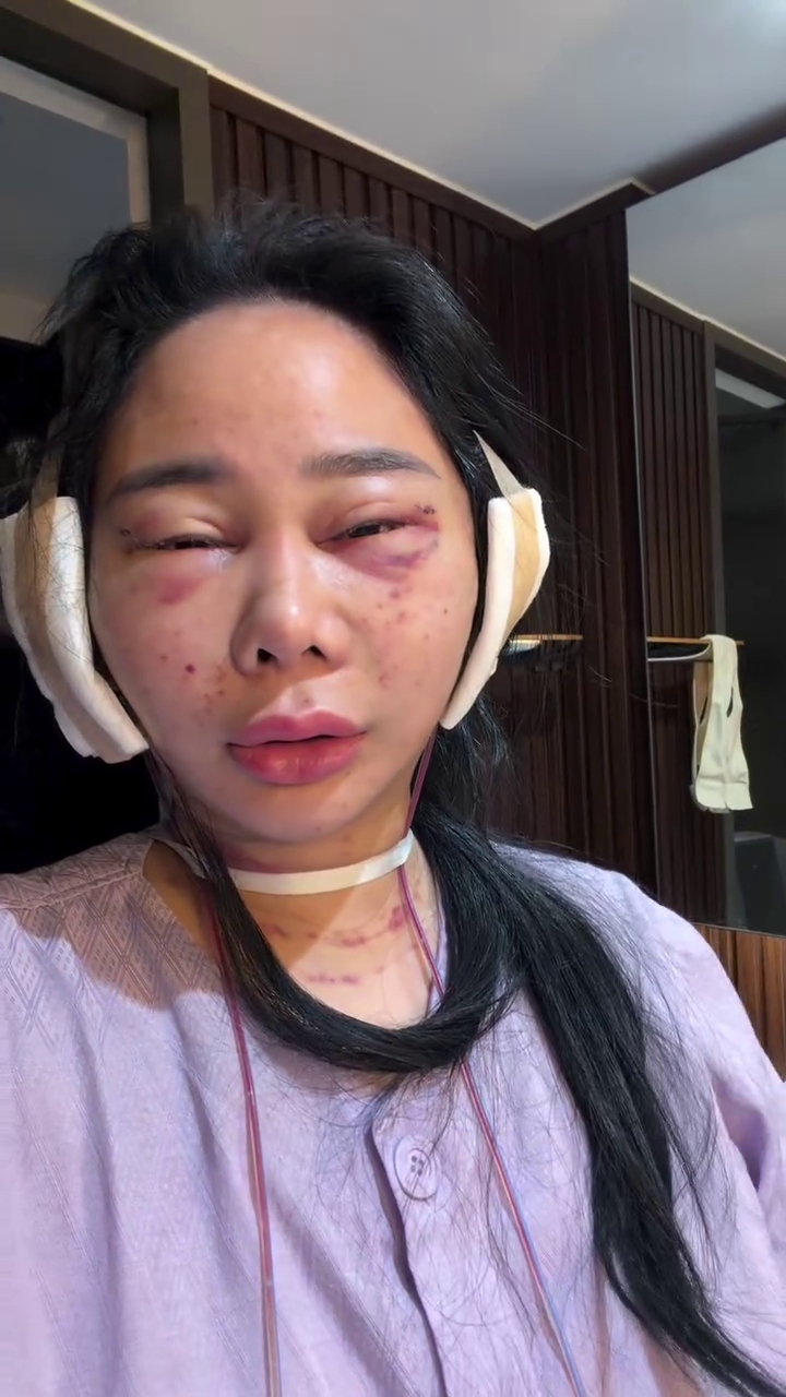 7 Potret Denise Chariesta jalani oplas wajah di Korea Selatan, ngaku habiskan dana Rp1 miliar