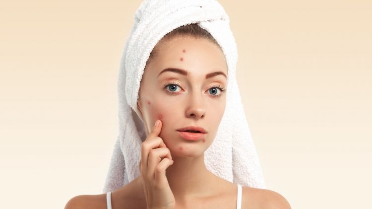Tanpa serum acne, cara pudarkan bekas jerawat membandel pakai pemanis alami yang mudah dicoba