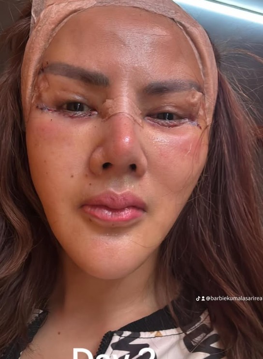 Menolak tua, Barbie Kumalasari sudah jalani operasi plastik 8 kali, ini 7 potret wajahnya kini