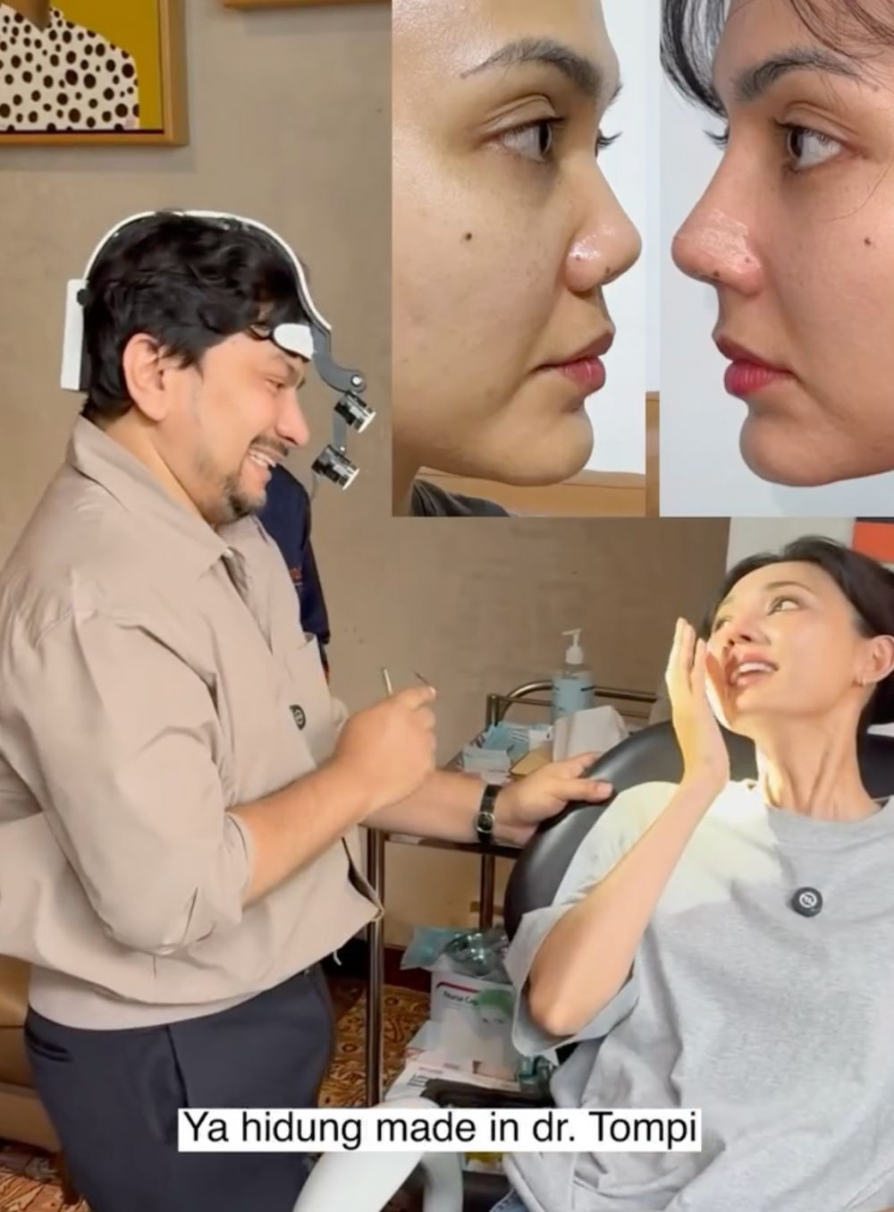 9 Potret Rina Nose pasca operasi hidung, hasil natural cantik tanpa bikin pangling