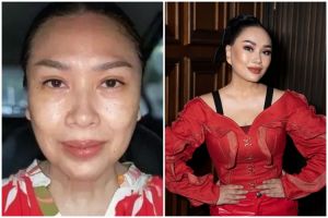 11 Potret seleb sebelum & sesudah operasi facelift di usia 40-an, wajah awet muda antikerutan