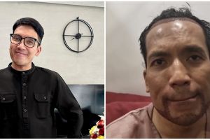 Merasa dahinya lebar, 9 momen Desta jalani transplantasi rambut dan jenggot ini telan duit Rp 110 juta