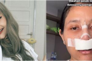 Lakukan operasi plastik pada bagian hidung biar tak dihina pesek, ini 7 potret terbaru Riyuka Bunga