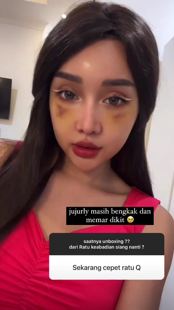 potret baru lucinta luna usai oplas © berbagai sumber