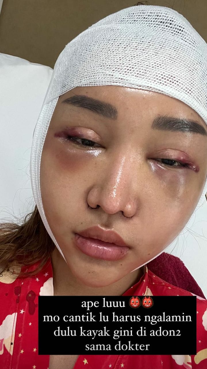 potret baru lucinta luna usai oplas © berbagai sumber