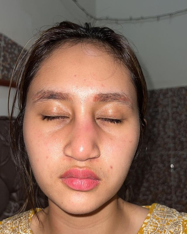 11 Potret Permesta Dhyaz, anak Farida Nurhan infeksi implan hidung