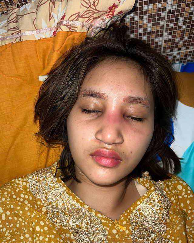 Permesta Dhyaz alami infeksi implan © Instagram/@permestadhyaz