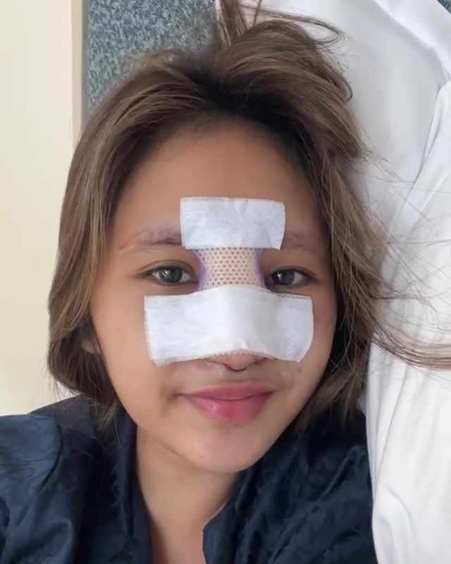 Potret kondisi Permesta Dhyaz usai angkat implan  © berbagai sumber