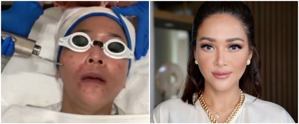 Maia Estianty sebelum dan usai botox-laser © Instagram
