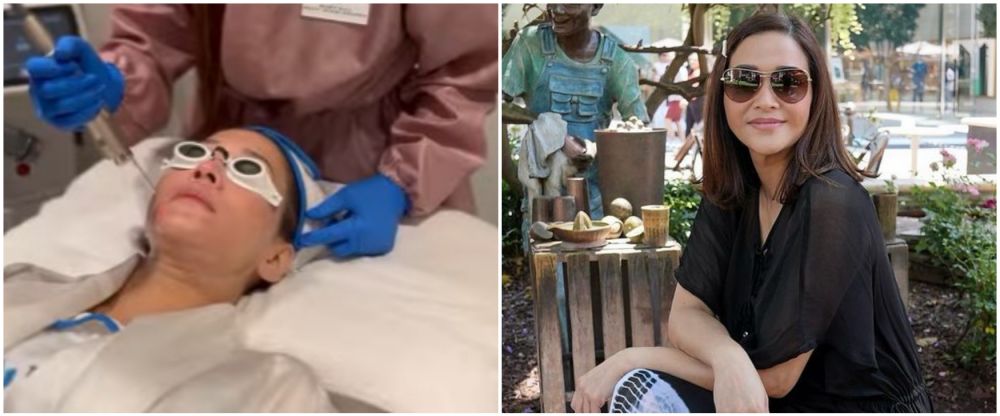 Maia Estianty sebelum dan usai botox-laser © Instagram