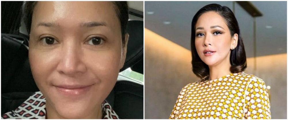 Maia Estianty sebelum dan usai botox-laser © Instagram Maia Estianty sebelum dan usai botox-laser © Instagram
