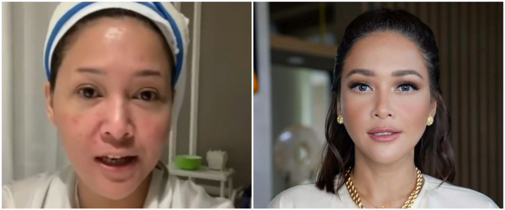 Maia Estianty sebelum dan usai botox-laser © Instagram Maia Estianty sebelum dan usai botox-laser © Instagram