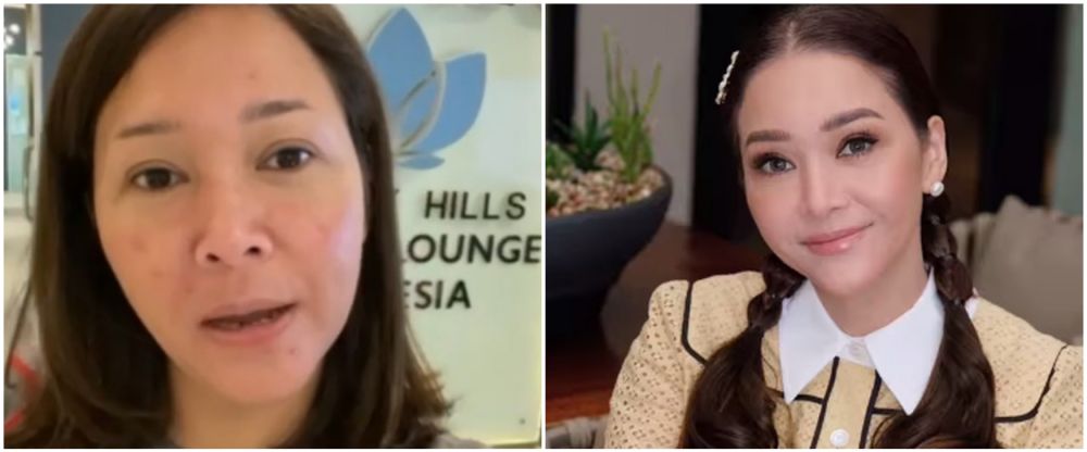 Maia Estianty sebelum dan usai botox-laser © Instagram Maia Estianty sebelum dan usai botox-laser © Instagram