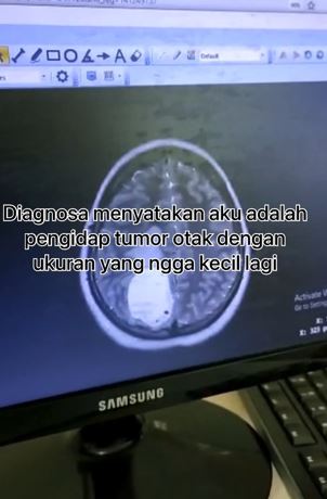 Kisah pilu wanita idap penyakit tumor, berawal dari sakit kepala TikTok Kisah pilu wanita idap penyakit tumor, berawal dari sakit kepala TikTok