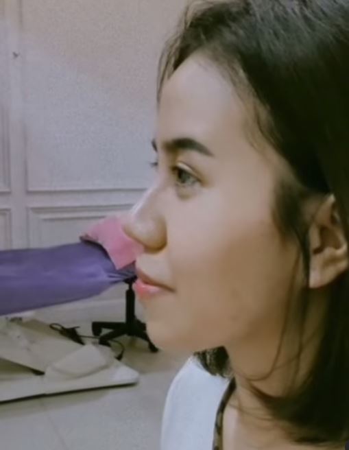 Mayang usai lepas perban operasi © 2022 Instagram 