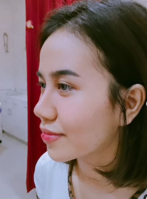 Mayang usai lepas perban operasi © 2022 Instagram 