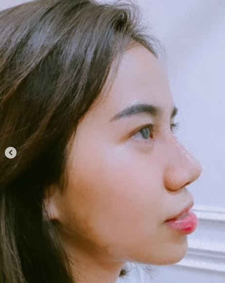 Mayang usai lepas perban operasi © 2022 Instagram Mayang usai lepas perban operasi © 2022 Instagram