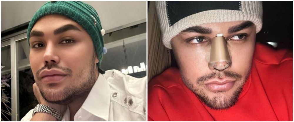 Ivan Gunawan jalani operasi hidung © Instagram