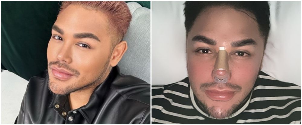 Ivan Gunawan jalani operasi hidung © Instagram