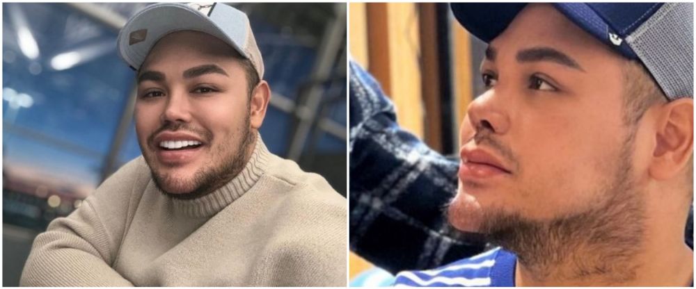 Ivan Gunawan jalani operasi hidung © Instagram