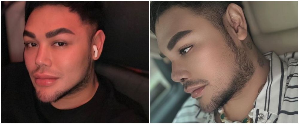 Ivan Gunawan jalani operasi hidung © Instagram