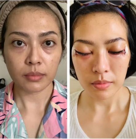 potret terbaru Yenny AFI setelah operasi plastik hidung © 2022 berbagai sumber